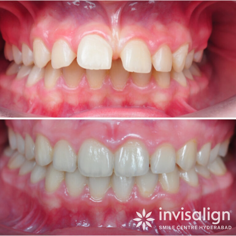 KIGO-DENTAL-Before-After-14