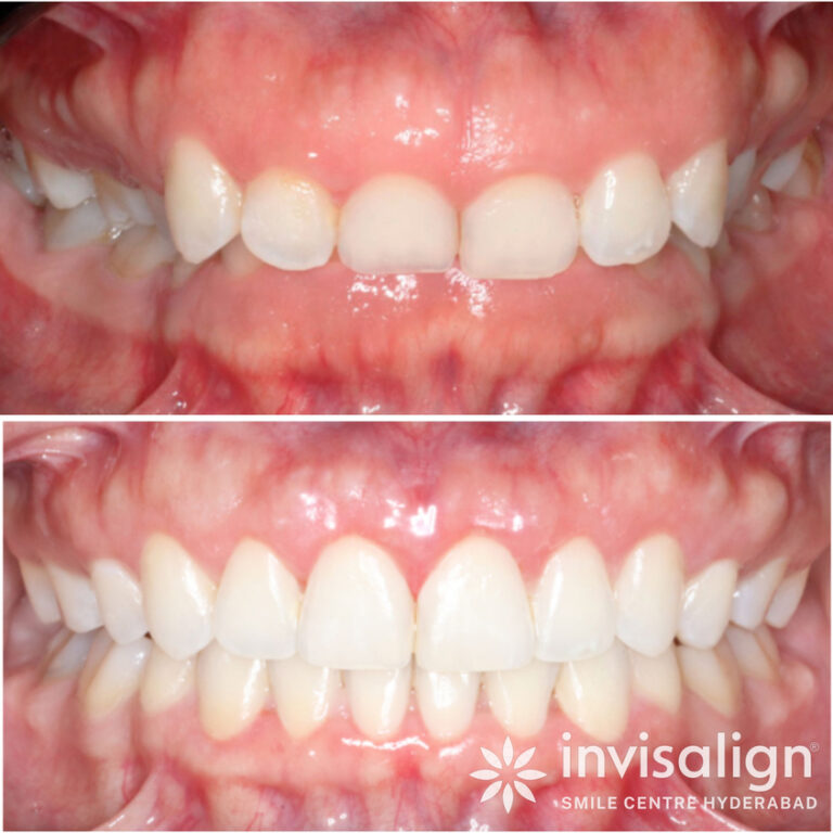 KIGO-DENTAL-Before-After-17
