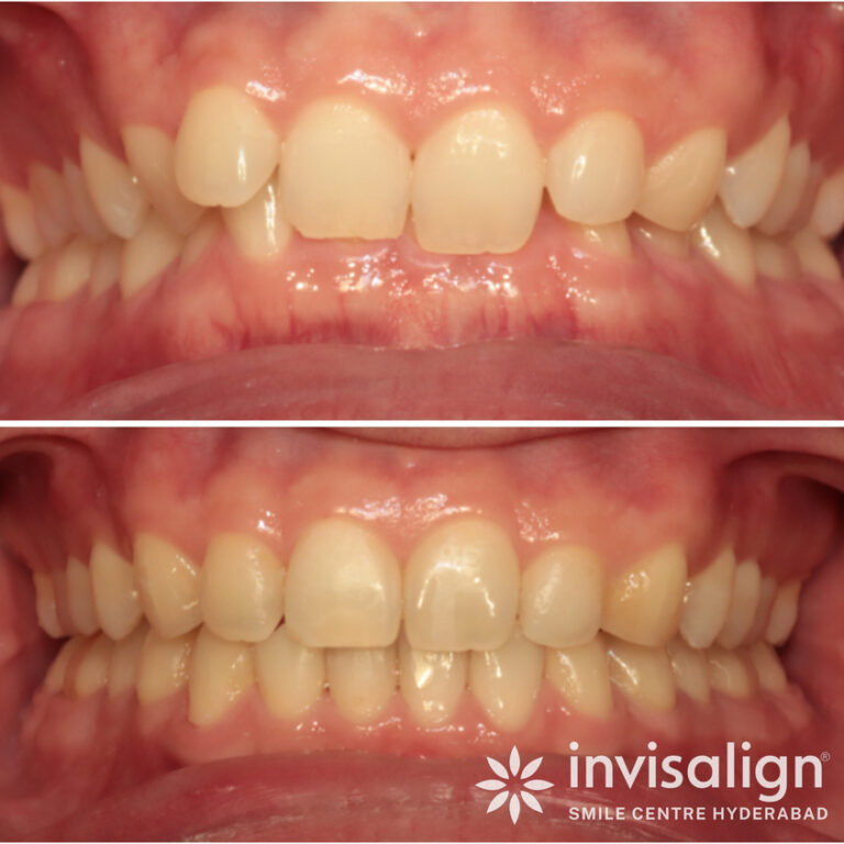 KIGO-DENTAL-Before-After-23